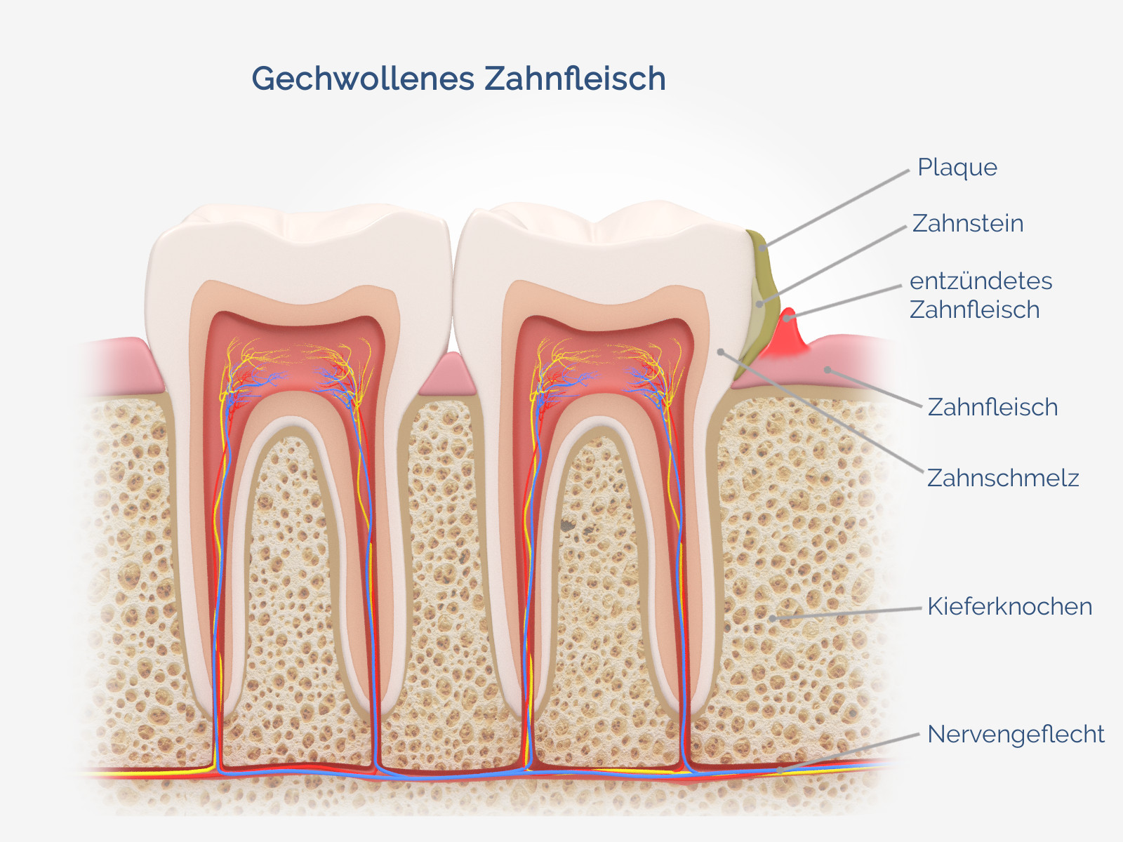 Zahnfleisch weisheitszahn drückt gegen Zahnschema ►
