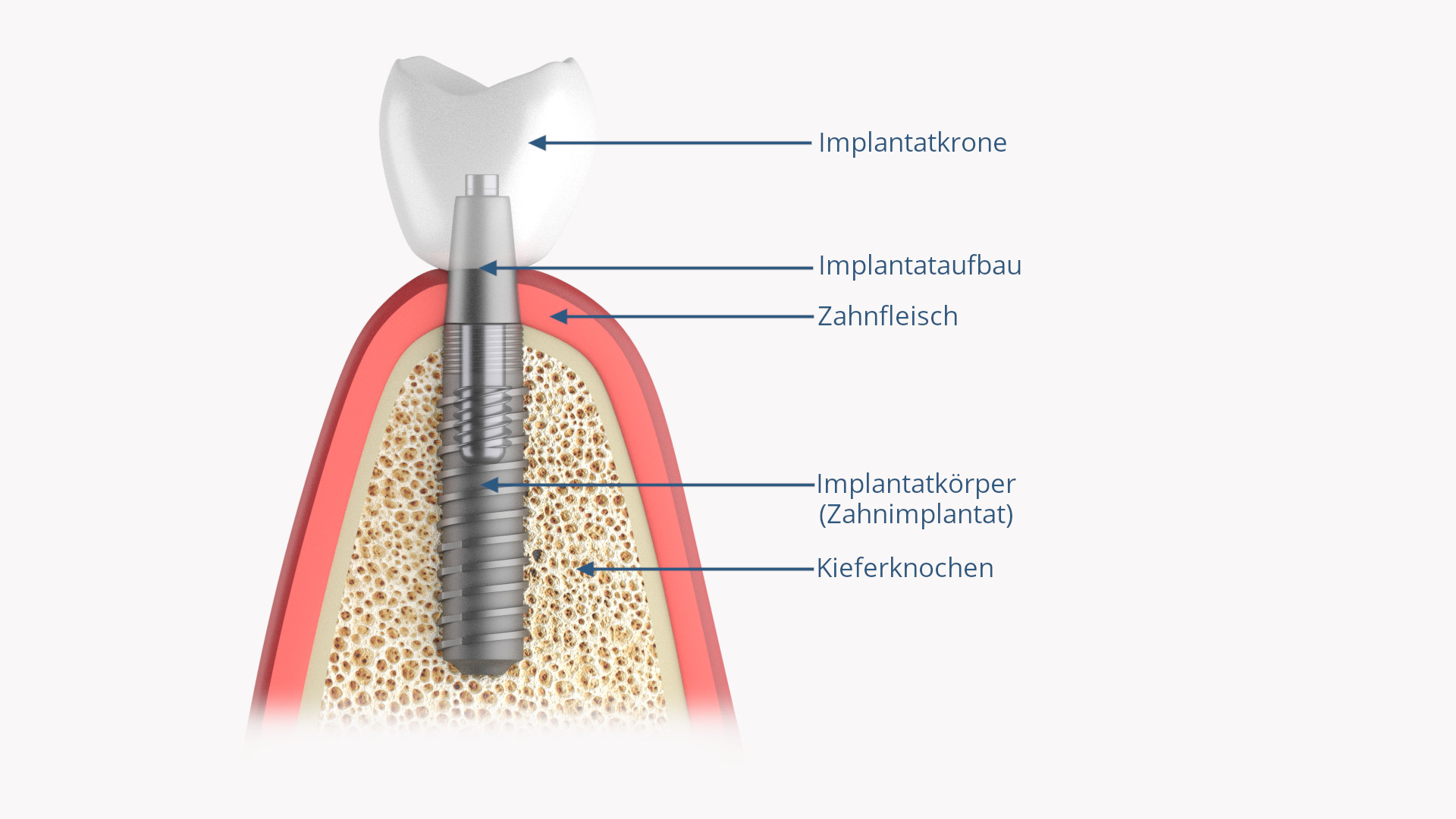Zahnimplantat implantiert