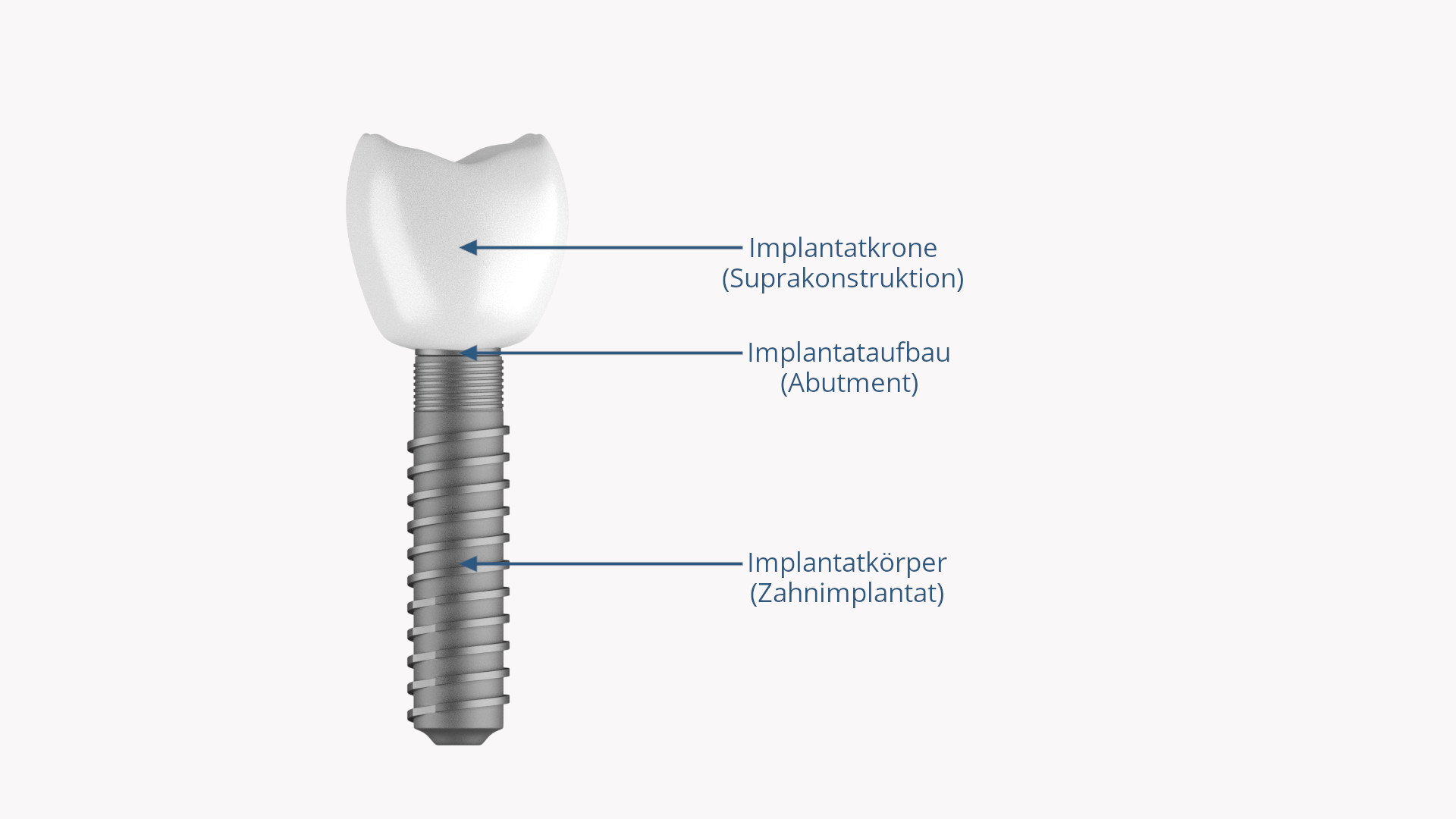 Zahnimplantat mit Suprakonstruktion
